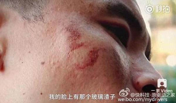 男子手部和臉部不同程度被炸傷。 男子手部和臉部不同程度被炸傷。